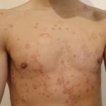 Psoriasis 